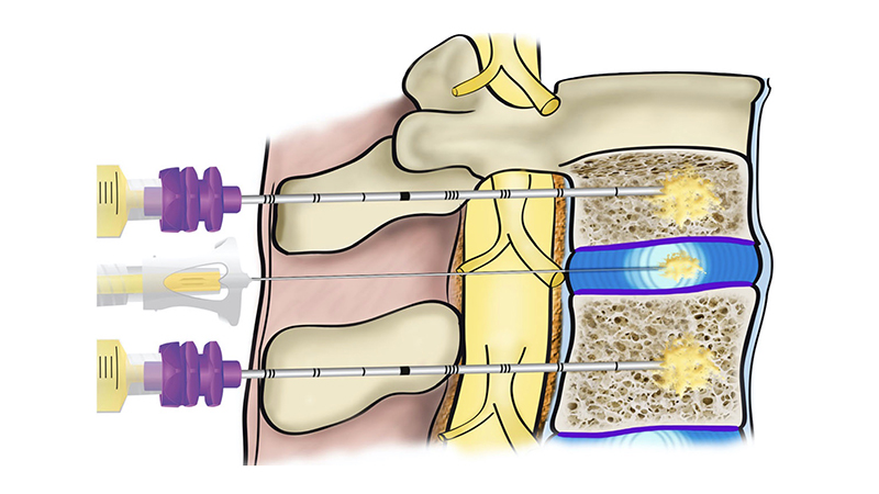 Durch die Vielfältigkeit der Wirkmechanismen ist PRP prädestiniert für die Behandlung von Rückenleiden